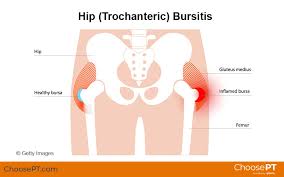 Image result for Bursitis