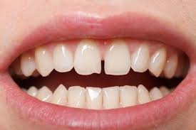 How much will it cost for a repair? realself.com, 14 sept. Is A Chipped Tooth Repair Worth It