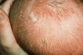 Image result for white scabs on the head in children