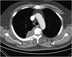 Symptoms of cancer that has spread to the bone. When Back Pain Turns Deadly An Unusual Presentation Of Lung Cancer Sciencedirect