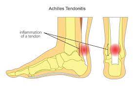 Achillestendon rupture management how to use a conservative approach to treat achillestendon rupture powered by physiopedia start. Achilles Tendonitis Injury Causes Treatment Gleneagles Hospital
