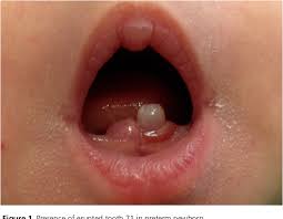 Image result for Neonatal Teeth