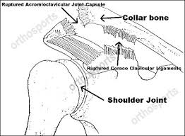 Maybe you would like to learn more about one of these? Acromioclavicular Joint Separation Orthosports Orthopaedic Surgeons