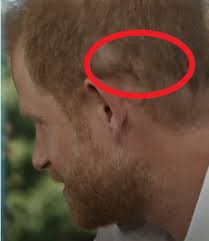 Prince Harry's Hair Transplant – Did It ...