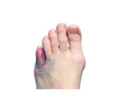Toe Fractures Metatarsal Fractures Broken Toe Broken Foot