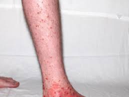The chief symptoms of the condition are rashes that are often accompanied with small bruises. Henoch Schonlein Purpura Dermnet Nz