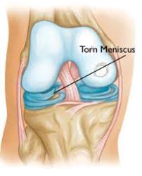 In mild to moderate injury, the healing time frame may be 2 to 4 weeks. Common Knee Injuries Orthoinfo Aaos