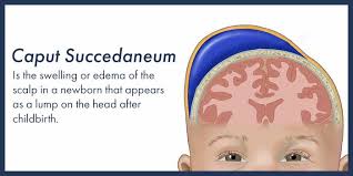 Image result for Vacuum Caput