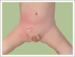 Image result for Inguinal hernia child