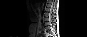 Wie kommt man in die röhre bei einer mrt an der lws? Mvz Diagnostikzentrum Radiologie Marburg Mrt Lws