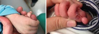 Image result for Supernumerary Digit