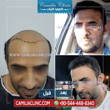 hair transplant in turkey beforeafter camilia clinic implanted grafts 7000 one session using percutan te incoming call screenshot clinic movie posters