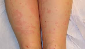 Image result for Erythema Multiforme Major