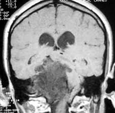 Neuralgia Del Trigemino Unidad De Neurocirugia Rgs