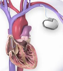 By doing so, we are making valuable contributions to the continuing development of a learning and empowered society for the benefit of our stakeholders. Implantable Cardioverter Defibrillator Icd American Heart Association