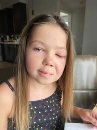 Aubriana is doing great. She is very swollen right now but was so happy to  get a shower and get the wrap off her head. She has stitches