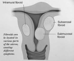 A uterine fibroid is a common, benign (not cancerous) tumor that occurs on the smooth muscle of the wall of what are the signs and symptoms of uterine cancer vs. Fibroid Tumors Symptoms Florida What Are Uterine Fibroids Aventura Fl Fibroid Tumors In Uterus South Florida Myfibroidtreatment Com