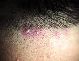 Image result for Deep Folliculitis