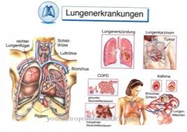 Perkongsian doktor ini amat bermanfaat untuk menanganinya. Pneumonia Punca Gejala Rawatan Penyakit