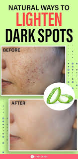 One of the most important ingredients in many home remedies includes age spots is apple cider vinegar. How To Remove Dark Spots On Face Fast 6 Home Remedies Dark Spots On Face Lighten Dark Spots Dark Spots On Skin