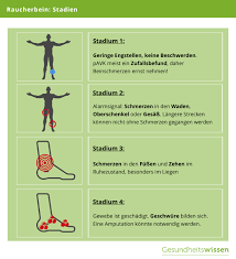 Raucherbein Ursachen Risikofaktoren Behandlung