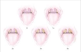 Standardized Tonsillar Hypertrophy Grading Scale 0
