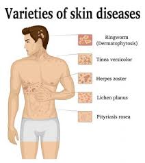 The disease is more common in males and usually occurs in young adulthood, although it has been seen in every age group and every. Pityriasis Free Vector Eps Cdr Ai Svg Vector Illustration Graphic Art