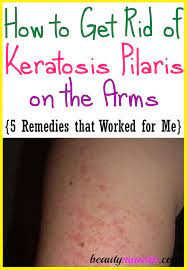 How To Get Rid Of Keratosis Pilaris On Arms Beautymunsta Free Natural Beauty Hacks And More Keratosis Pilaris How To Get Rid Of Acne Natural Beauty Tips