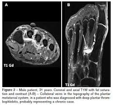 Differential diagnostic considerations specific to the pa, however, include numerous diseases and pathologic processes (,4,,5). Scielo Brasil Tromboflebite Plantar Achados Em Ressonancia Magnetica Tromboflebite Plantar Achados Em Ressonancia Magnetica