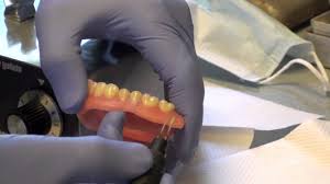 Yes, the soft relign material does taste awful. Denture Soft Reline Part 2 Youtube