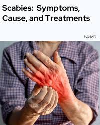 Image result for human scabies