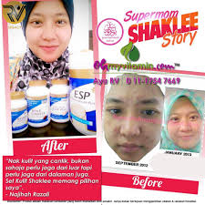 Laman doctoroncall ada jawapan berkenaan isu tersebut, sila baca. Wanita Ini Kongsi Cara Hilangkan Parut Chicken Pox Coach Bisnes Coach Detox Kurus Coach Penyusuan Susu Ibu Mentor Bisnes Pengedar Shaklee Pengedar Youth Pengedar Vivix 011 17547669