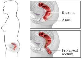 Image result for Rectal prolapse