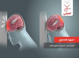 ارتجاج المخ Brain Concussion الأسباب وطرق العلاج ملف شامل تمرجي