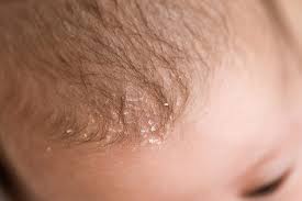 Image result for white scabs on the head in children