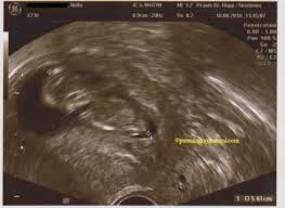 Wanita yang hamil 11 minggu dengan bayi kembar sering mengalami peningkatan kadar hormon, yang dapat berarti menggandakan gejala dan menambah berat badan. Cerita Trimester Pertama Hamil Anak Kedua Pursuing My Dreams