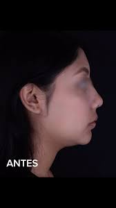 Te muestro el antes y después a corto plazo ( 2 semanas de postoperatorio)  de cirugía ortognatica u OrtoFacial! , Podemos ver cambios en el tercio  medio e inferior de la cara, adecuada posición de los ...