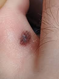 Subungual melanomas usually appear as a brown or black streak under the nail. Spot I Found Between Toes Think It S A Blood Blister But Would Like Insight Melanoma