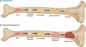 Image result for Osteosarcoma