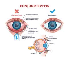 Image result for Conjunctivitis Resources