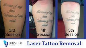 Laser tattoo removal involves breaking down the unwanted pigment from the tattoo by targeting the skin with short bursts of concentrated light. Dermdox Dermatology On Twitter Laser Tattoo Removal Update 5 Sessions In And Bob Regret Is Disappearing Tattooregret Tattoo Skincare Https T Co Xcv6n8epge Https T Co G2w3d1f11f