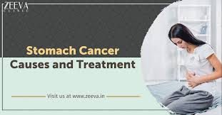 Early stomach cancer symptoms are typically so unremarkable that they go completely unnoticed. Stomach Cancer Causes And Treatment Cancer Specialist Zeeva Clinic