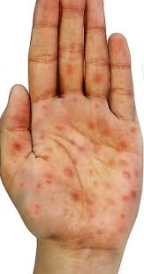 Image result for syphilis symptoms