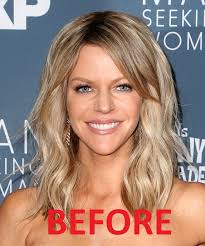 I Think Its Time We Talked About Dee S Plastic Surgery Look At This Before After Album On Imgur