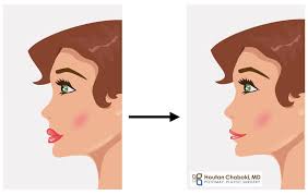 When comparing pictures of her from . Removing Facial Fillers With Hyaluronidase Injection
