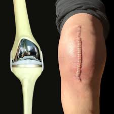 The size, colour, texture and overall healing of knee scars can vary drastically from person to person. Total Knee Replacement A Survivor S Guide
