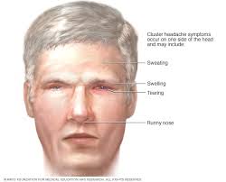 It was first identified in december 2019 in wuhan,. Cluster Headache Symptoms And Causes Mayo Clinic