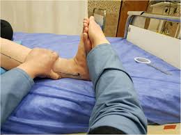 Patients do not or can not reposition themselves. The Effect Of Adding Tens To Stretch On Improvement Of Ankle Range Of Motion In Inactive Patients In Intensive Care Units A Pilot Trial Bmc Sports Science Medicine And Rehabilitation