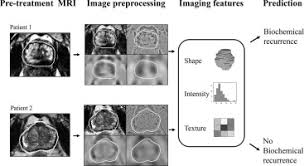 Some combinations of minor prostate cancer (e.g. Biochemical Recurrence Prediction After Radiotherapy For Prostate Cancer With T2w Magnetic Resonance Imaging Radiomic Features Physics And Imaging In Radiation Oncology