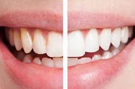 Aturan Pakai Pasta Gigi Pemutih